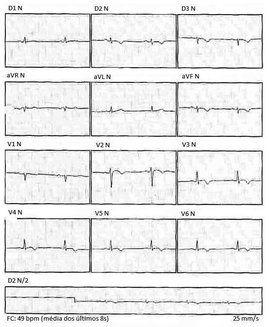 Int J Cardiovasc Sci. 2016;29(5):407-411 409 Figura 2 Eletrocardiograma de 12 derivações, em ritmo sinusal, evidenciando inversão de onda T em D2, D3, AVF, V2 a V6.