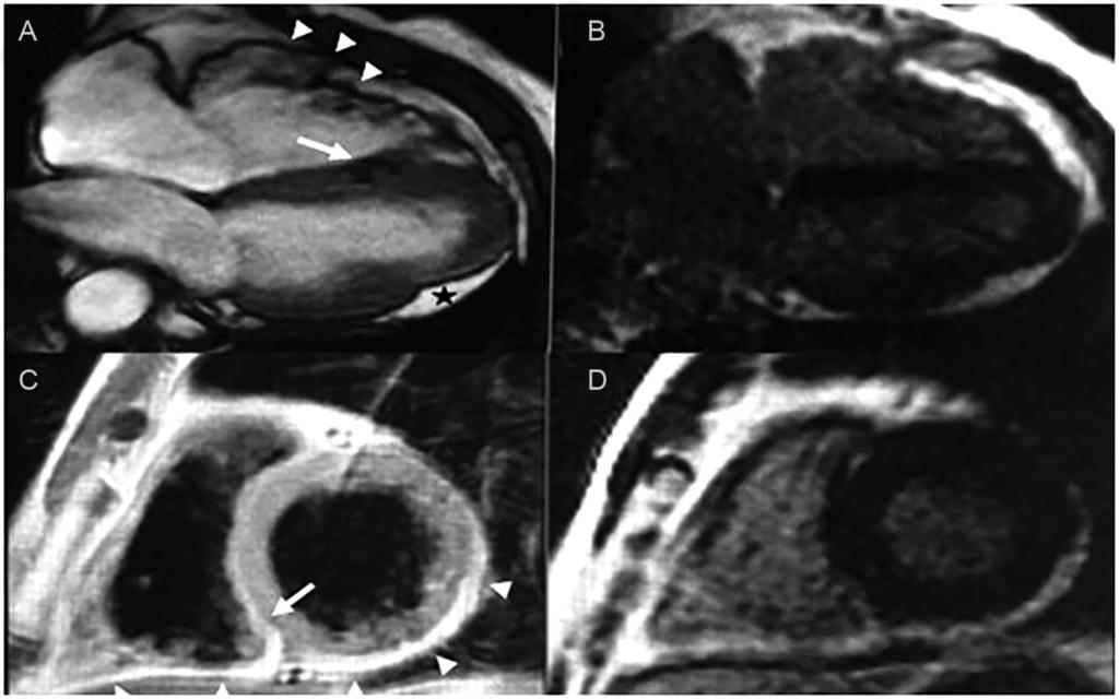 410 Int J Cardiovasc Sci. 2016;29(5):407-411 Figura 3 Ressonância Magnética Cardíaca no eixo longo, quatro câmaras, A e B e RM Cardíaca no eixo curto, C e D.