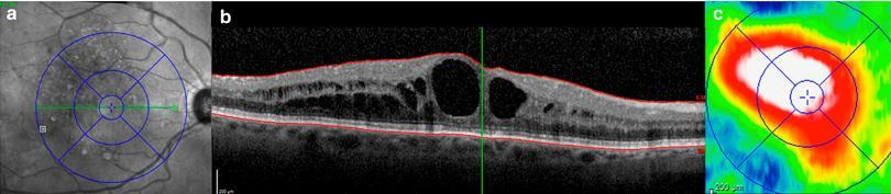 36 FIGURA 1 - Exemplo de análise de protocolo de espessura retiniana central ao exame de tomografia de coerência óptica de domínio espectral Fonte: Ibrahim et al. 80 4.