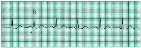 (39) BIOENGENHARIA - EletroCardioGrama (ECG) AMPLIFICADOR DE INAI PARA MEDIÇÃO DE ELETROCARDIOGRAMA Uma vez que o ECG produz potenciais elétricos muito baixos, é necessário amplificálos para obter