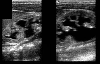 Caso Clínico 1 Ecografia renal Hidronefrose esquerda Caso Clínico 1 O que fazer? A.