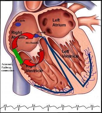 Wolff-Parkinson-White Via acessória