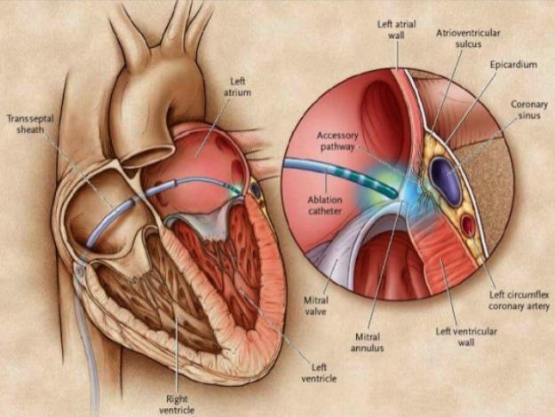 Taquicardia supraventricular Após reversão a RS ECG (vias