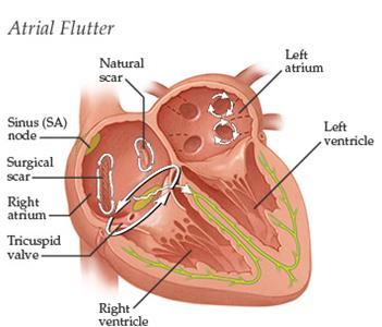 Flutter auricular Taquicardia de reentrada intra-auricular Via de re-entrada localizada na AD, a circundar o anel da