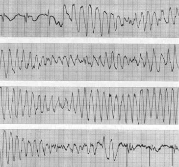 Torsades de pointes Taquicardia ventricular multiforme com alterações