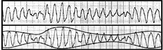 transição estreitos Polaridade do QRS gira repetitivamente em volta