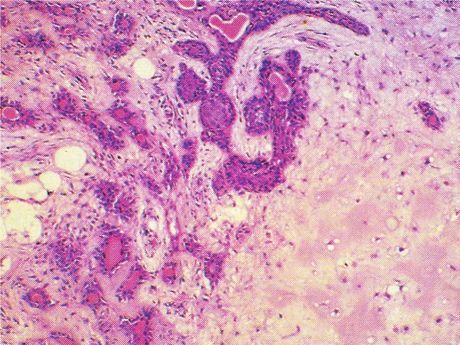 Figura 2 - Aspecto microscópico do adenoma pleomórfico, exibindo células epiteliais, dispostas em lençol ou cordões e estroma (HE - 40x) Figura 3 - Corte axial de Tomografia Computadorizada, na qual