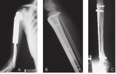 Camargo OP, Baptista AM. Neoplasias músculo esqueléticas malignas. osteossarcoma, porém utilizando-se outras drogas.