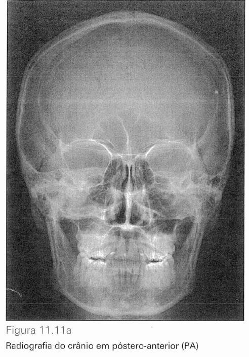 O paciente deve permanecer imóvel e em apneia durante a realização da incidência. Posição do paciente (Fig. 11.