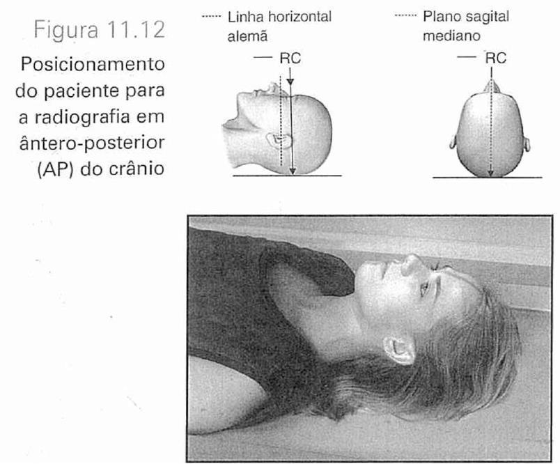 Ântero-posterior (AP) Também denominada incidência fronto-occipital, ou AP do crânio, é usada como uma opção quando não se consegue mobilizar o paciente para o posicionamento em póstero-anterior