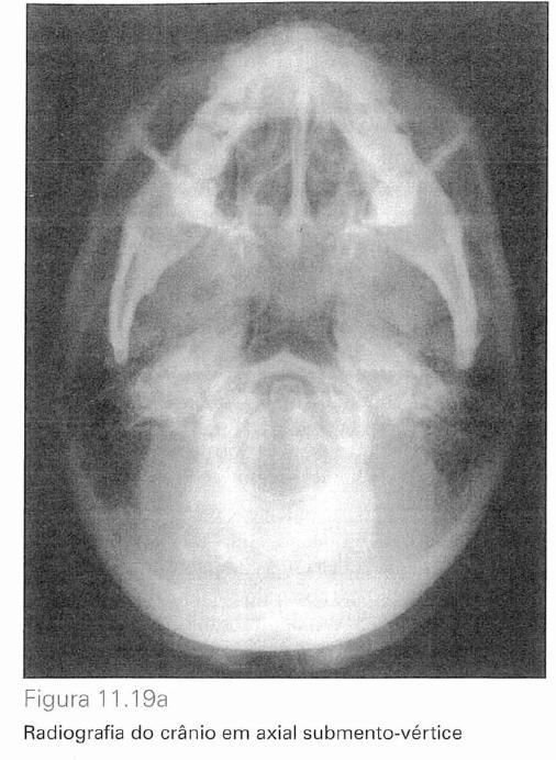 Posição da cabeça do paciente O pescoço deve ser estendido de maneira que a região superior da cabeça (vértice) fique mais próxima do filme radiográfico.