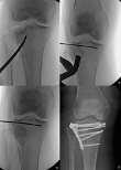 Caso haja associação da impacção com deslizamento ( split ), devemos abrir gentilmente o foco de fratura e realizar a elevação em bloco do osso impactado com auxílio de impactores, cureta ou