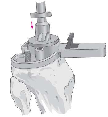 Após ter sido efectuado o corte da extremidade proximal da tíbia tem de fazerse o furo para encaixe da haste e das nervuras da componente tibial.