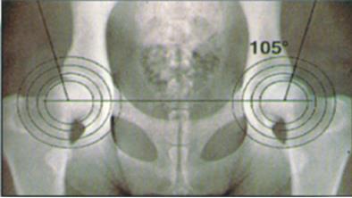 25 FIGURA 7 A sobreposição de uma das circunferências concêntricas ao limite da cabeça femoral determinara o centro da referida cabeça femoral, índice de Norberg.