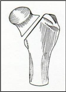 28 A colocefalectomia (Figura 9) gera uma pseudo-articulação fibrosa, aliviando a dor pela eliminação do contato ósseo entre o fêmur e a pelve (FOSSUM E SCHULZ, 2014).