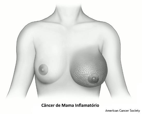 Câncer de Mama Triplo-negativo - Este termo é usado para descrever os cânceres de mama cujas células não são receptores de estrogênio e progesterona, e não tem excesso da proteína HER2.