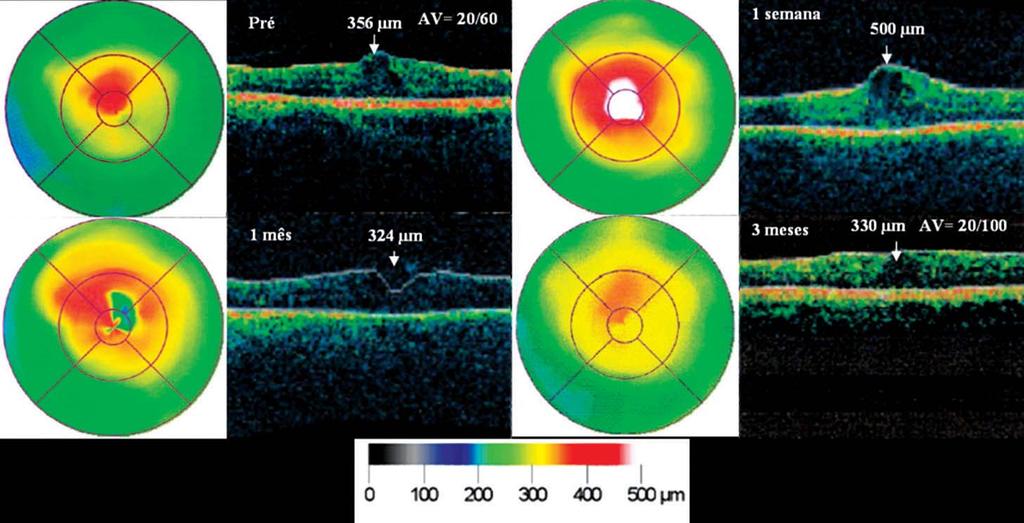 Espessura macular e acuidade visual na retinopatia diabética tratada por panfotocoagulação 397 Figura 2 - Paciente do Grupo 2, sexo feminino, 64 anos, submetida à panfotocoagulação no OD por