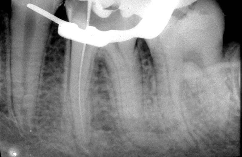 2-A, após o uso da técnica da Inversão Sequencial Baseados em dados apresentados por PUCCI18 e REIG 12 (1991) e DE DEUS 2 (1992) a respeito do comprimento das coroas e das raízes dos dentes, pode-se