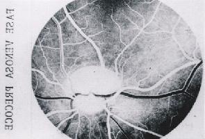 82 A Angiofluoresceinografia na Retinopatia Diabética O tempo venoso (fig. 4), pode ainda ser subdividido em fase venosa precoce e fase venosa tardia.