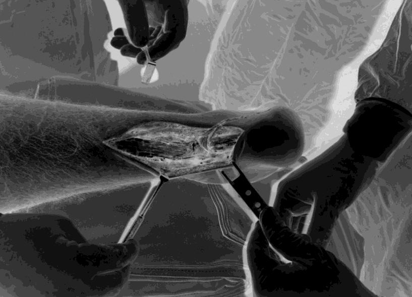 Ruptura do tendão calcâneo: mobilização e carga precoce após reparo cirúrgico A B C D Figura 1 - (A) Lesão do tendão calcâneo, aspecto