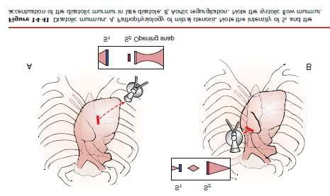 Para distinguir um atrito pericárdico de um pleural, pede-se ao doente para suster a respiração, o que fará desaparecer este último. O atrito pericárdico pode ser indicativo de infecção do pericárdio.