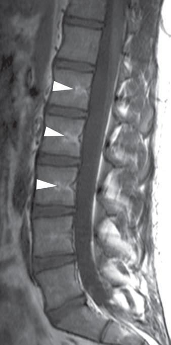 METASTIZAÇÃO ÓSSEA de PCa: RM Medula óssea normal: contém gordura e água (medula amarela: 80% gordura + 15% água;