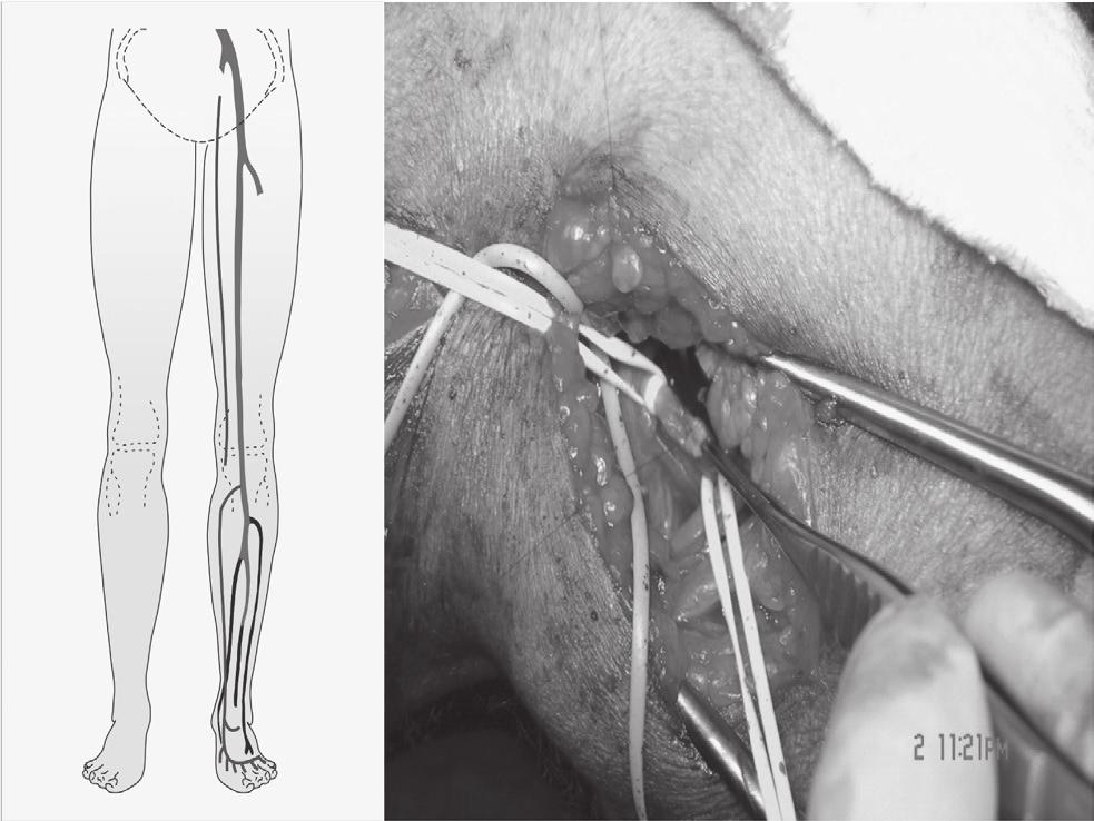 120 J Vasc Bras 2010, Vol. 9, Nº 3 Safena magna in situ para arterialização do arco venoso - Busato CR et al.