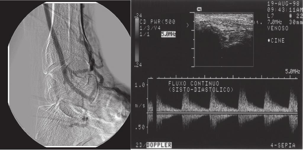 Dezoito pacientes com isquemia crítica sem leito arterial distal, dos quais 11 com AO, 6 com TO e 1 com evolução tardia de aneurisma de artéria poplítea com trombose distal foram submetidos ao método.