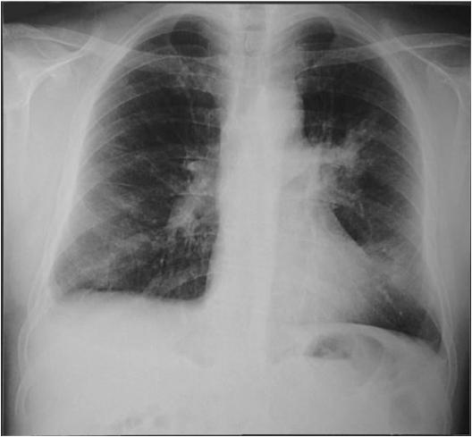 Radiografia do Tórax de 18/08/2003: Opacidades alveolares bilaterais