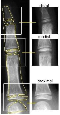 Como resultado das iterações o AAM gera pontos de contorno que serão utilizados para determinar os espaços, que nas imagens são os quadros destacados, que mostram a região de interesse. Nas figuras 6.