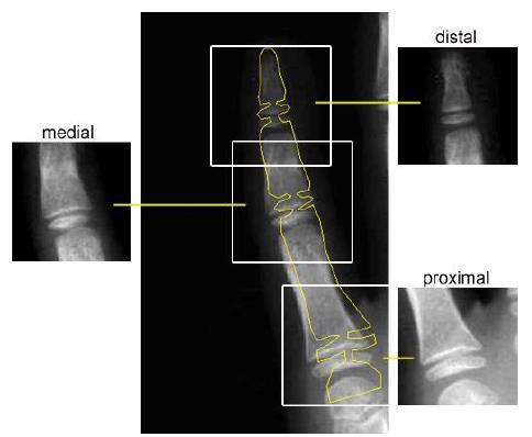 86 Figura 6.7 Espaços que mostram epífises do dedo V (mínimo) Fonte: Elaborado pelo autor (2015) Conforme descrito no parágrafo anterior, e observando as figuras 6.5, 6.6 e 6.