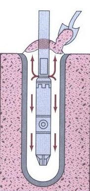 A partir da superfície é lançado material granular para preencher o espaço outrora ocupado pelo solo menos compacto, obrigando simultaneamente a água resultante do processo de cravação a aflorar à