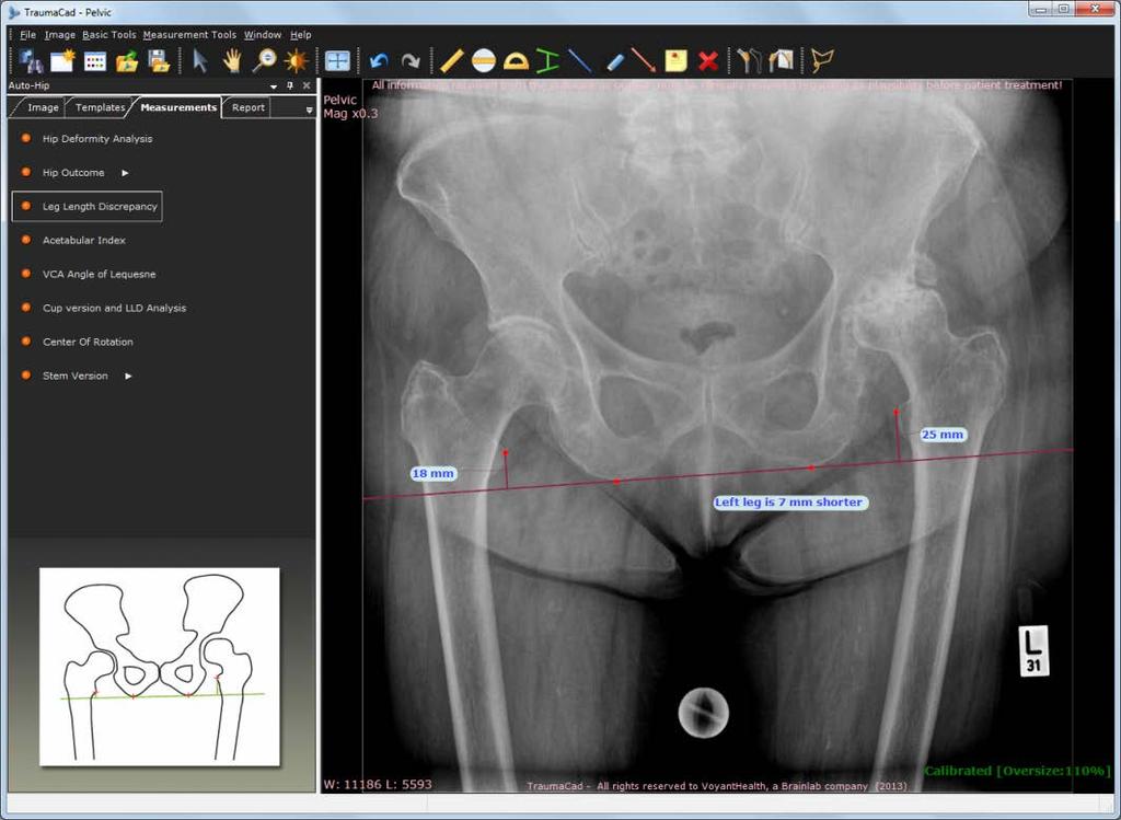 Medição da Anatomia Ferramenta de Discrepância do Comprimento da Perna A ferramenta de medição Discrepância do Comprimento da Perna permite-lhe medir a discrepância do comprimento da perna.