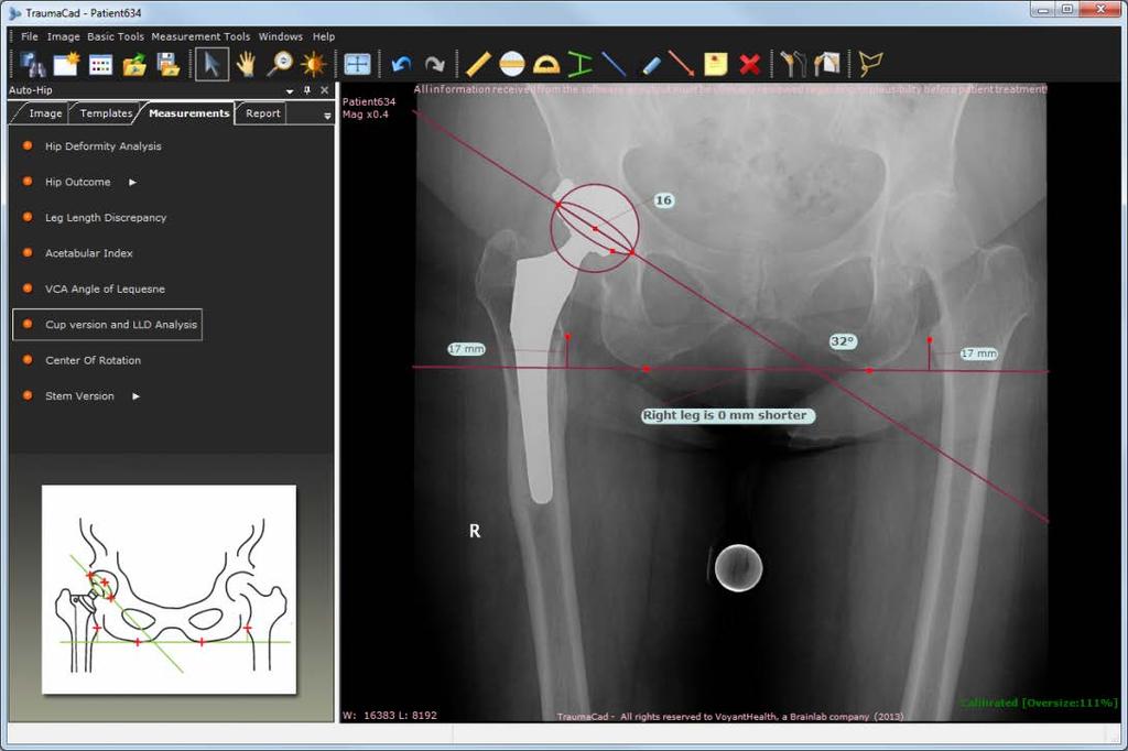 Guia do Usuário do TraumaCad Versão da copa e Análise LLD Quando é visto num ângulo, o componente acetabular de uma substituição total do quadril é projetado como uma elipse.