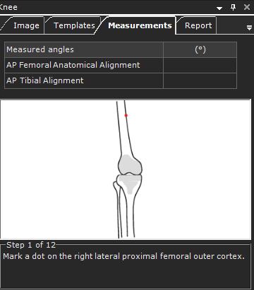 Medição da Anatomia Resultado do Joelho O Resultado do Joelho é utilizado para avaliar a posição dos implantes TKR femoral e tibial numa imagem pós-operatório para as vistas AP e LAT.