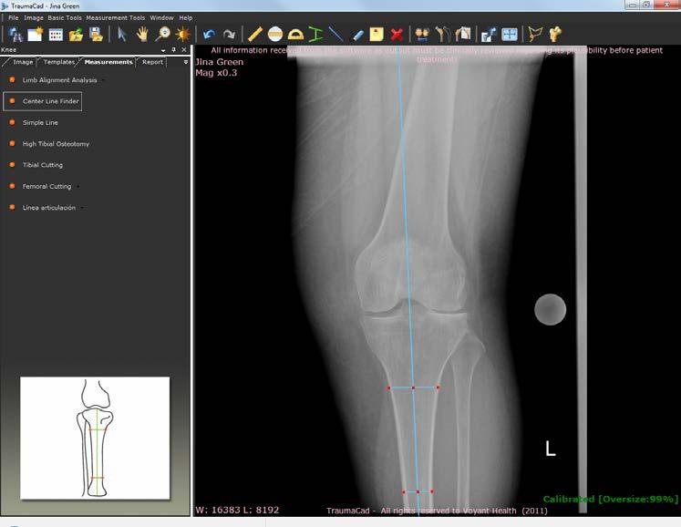 Guia do Usuário do TraumaCad Detector de Linha Central A ferramenta de medição Detector de Linha Central é utilizada para localizar a linha central dos ossos longos.