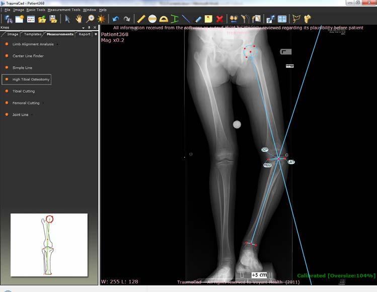 Guia do Usuário do TraumaCad Osteotomia Tibial Alta Esta ferramenta de medição é utilizada para medir o ângulo de correção de uma Osteotomia Tibial Alta (High Tibial Osteotomy - HTO), ou seja, o