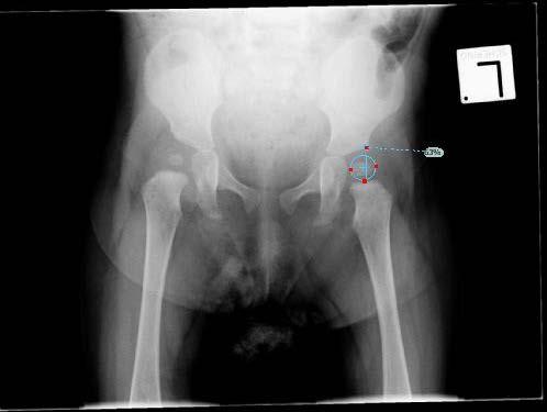 Guia do Usuário do TraumaCad Índice de Reimer O Índice de Reimer mede a percentagem de migração do quadril. Um círculo é ajustado à cabeça femoral ossificada.