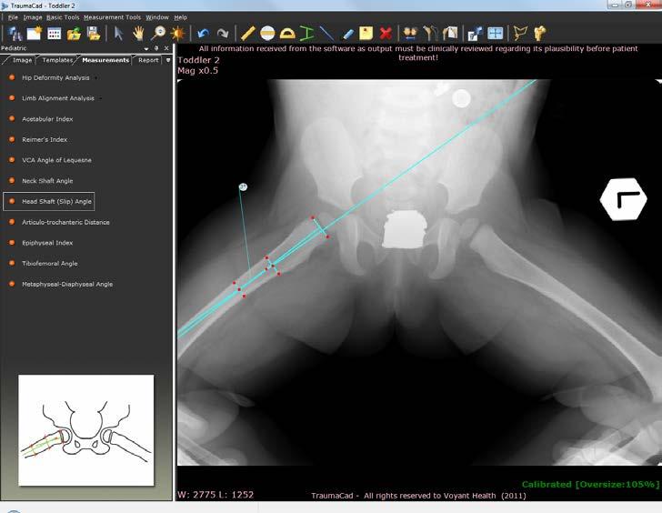 Medição da Anatomia Ângulo do Eixo da Cabeça (Deslize) O ângulo do eixo da cabeça (deslize) de Southwick tem sido utilizado para caracterizar a severidade do deslize na epífise femoral capital com