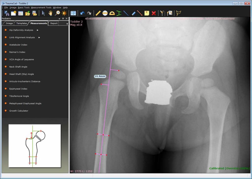 Guia do Usuário do TraumaCad Distância articulo-trocantérica Esta ferramenta de medição mede a distância vertical que vai da superfície articular superior da cabeça femoral ao ponto proximal do