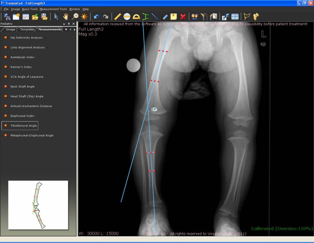 Guia do Usuário do TraumaCad Ângulo Tibiofemoral O Ângulo Tibiofemoral é o ângulo criado pela interseção dos eixos anatômicos do fémur e da tíbia.