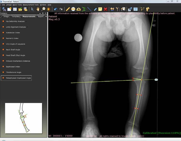 Medição da Anatomia Ângulo Metafisário-Diafisário O Ângulo Metafisário-Diafisário é o ângulo criado pela interseção de uma linha através do plano transversal da metáfise tibial proximal, com uma