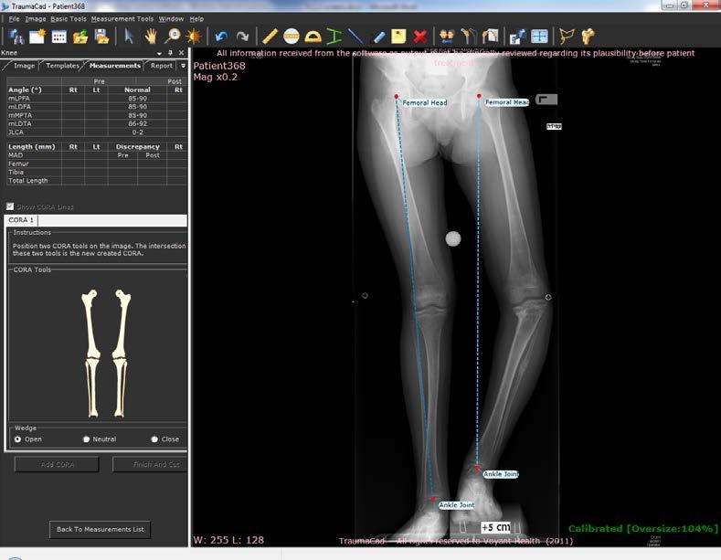 Guia do Usuário do TraumaCad Se, por algum motivo, pretender saltar essa etapa e realizar a simulação da osteotomia numa localização predeterminada, clique no botão Skip Wizard no aba Measurements e