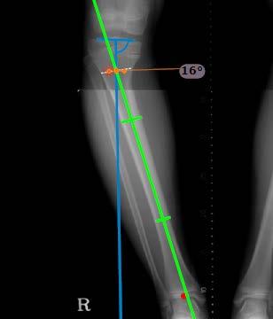 Medição da Anatomia 2 Clique para selecionar a primeira ferramenta. A ferramenta aparece na imagem.