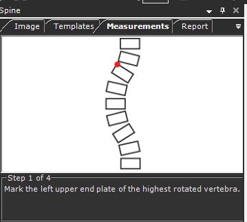 Guia do Usuário do TraumaCad Ângulo de Cobb A medição Ângulo de Cobb é utilizada para avaliação de curvas em escoliose numa projeção radiográfica AP da coluna.