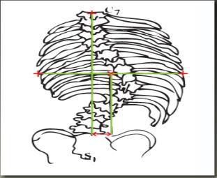 Medição da Anatomia Mudança do Tronco Torácico Esta ferramenta mede a mudança do tronco do centro de uma linha à altura da vértebra torácica apical à linha vertebral sacral central.