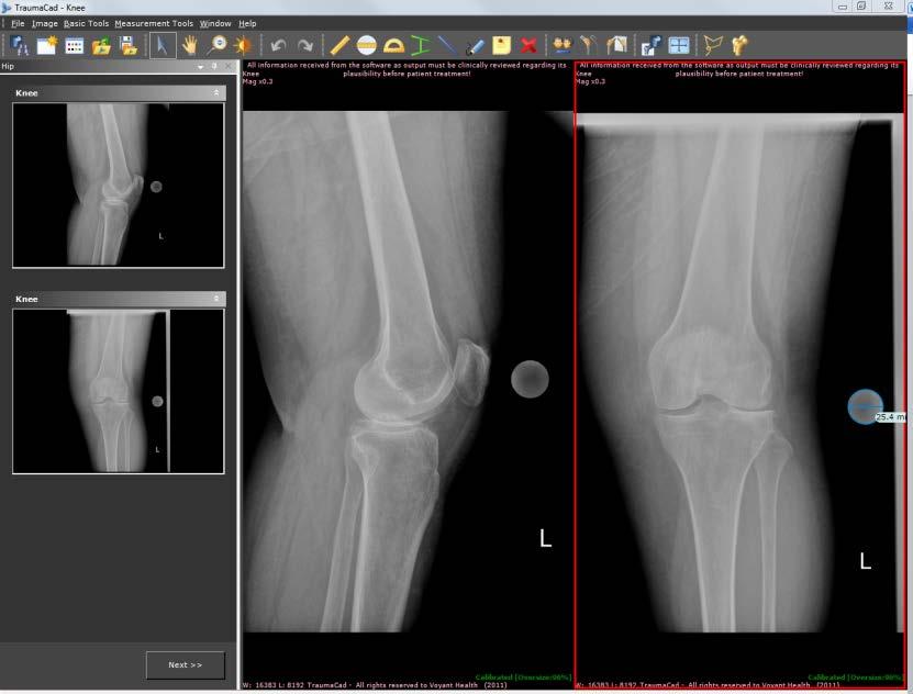 Guia do Usuário do TraumaCad Vistas Múltiplas A área de trabalho principal pode apresentar até quatro imagens em simultâneo. A imagem ativa tem um limite vermelho.