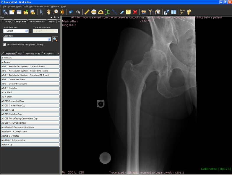 Planeamento da Cirurgia Selecionar um Implante É semelhante o processo de determinação do modelo para cada um dos procedimentos (, joelho, membro superior, pediátrico, deformidade, trauma, coluna e