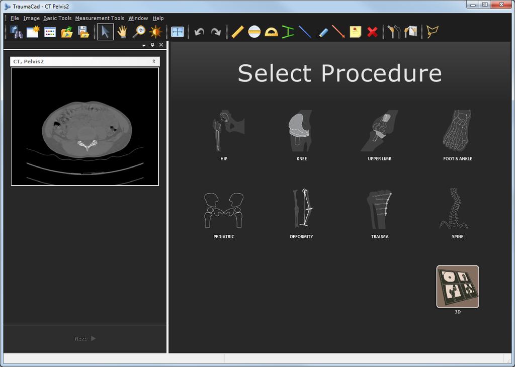 Planeamento da Cirurgia 3D Suite (Opcional) O módulo 3D do TraumaCad 3D permite-lhe ver imagens, como TC e IRM, em três dimensões, utilizando a Reconstrução Multi-Planar (Multi-Planar Reconstruction