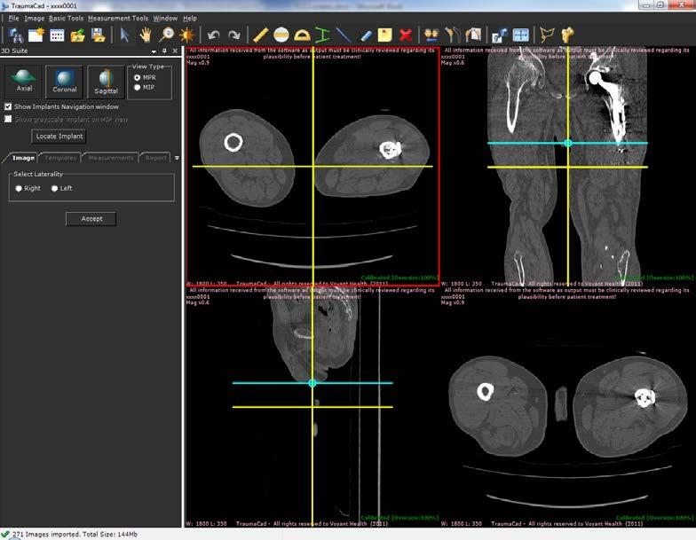 Guia do Usuário do TraumaCad Abrir uma Imagem 3D Para ativar o procedimento 3D, selecione um estudo com 6 ou mais imagens.